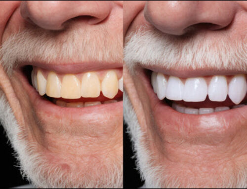Unveiling the Bright Side: The Benefits of Teeth Whitening