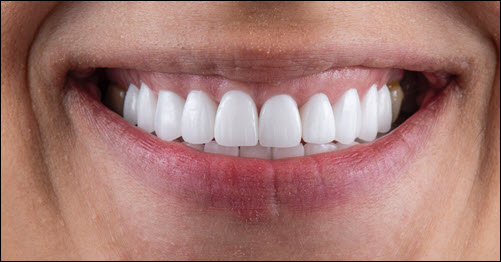 Veneers