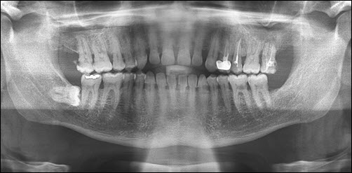 Wisdom teeth