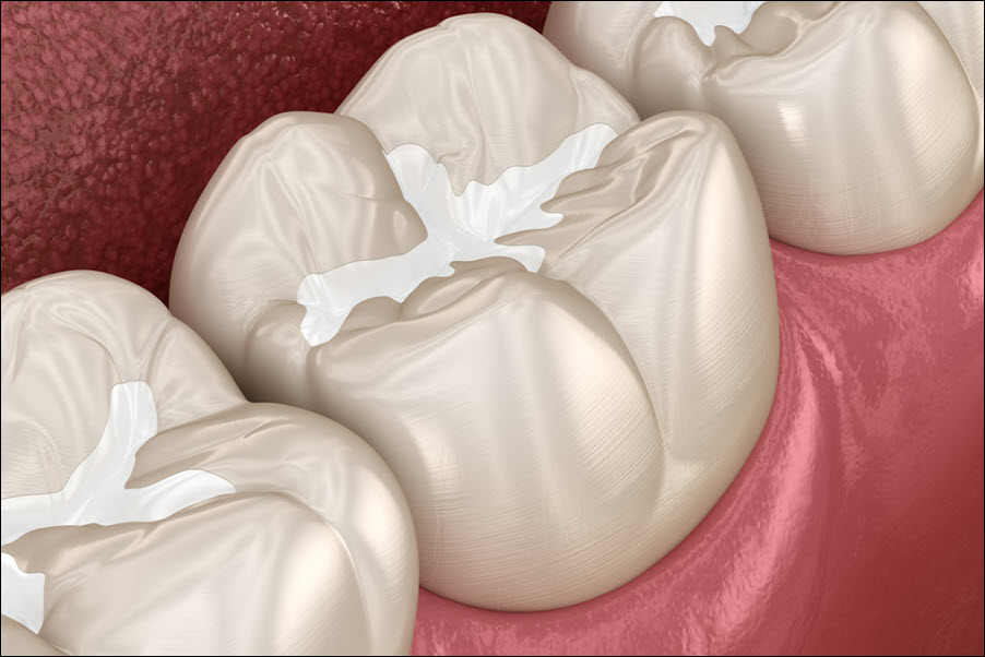 Dental Sealants