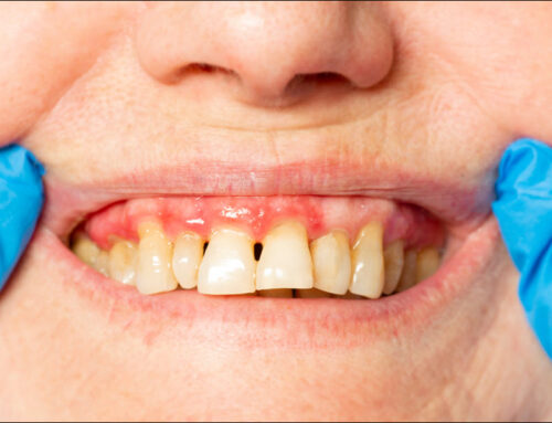 Preventing and Curing Gum Disease