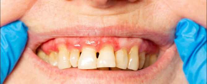 Gingivitis