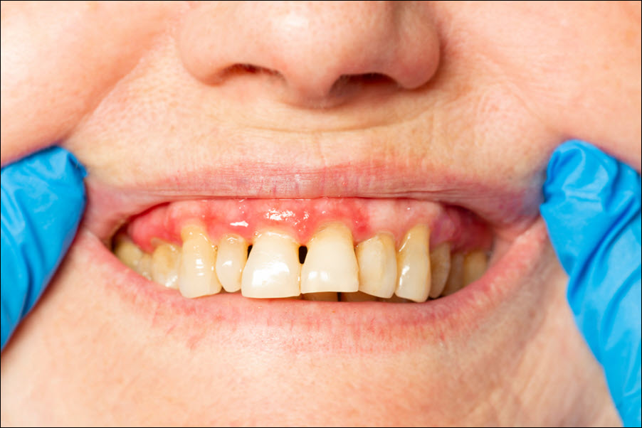 Gingivitis