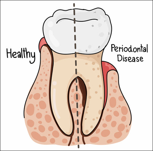 Gingivitis