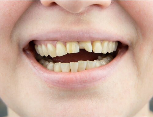 The Benefits of Dental Bonding for Small Imperfections