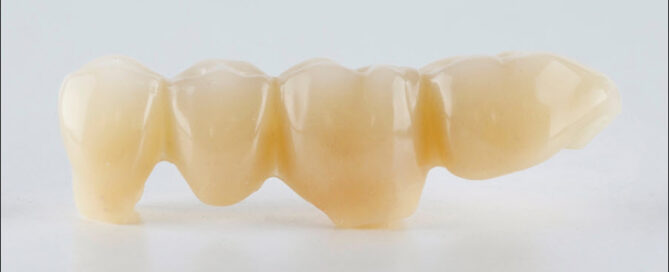 Dental Bridges
