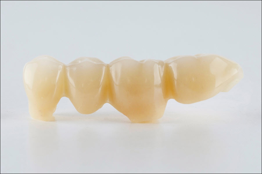 Dental Bridges