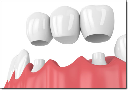 Dental Bridges