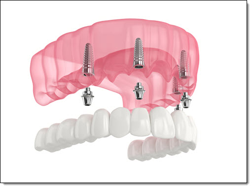 Dental Implants