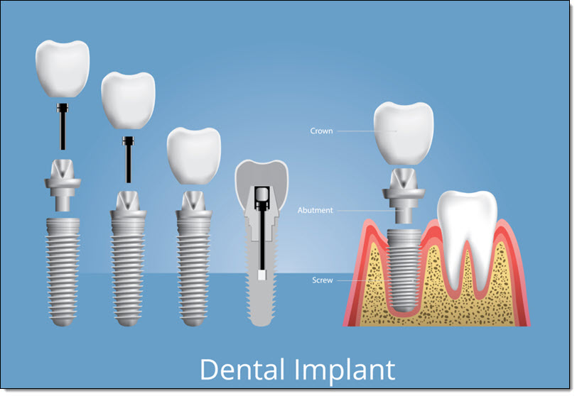 Implants