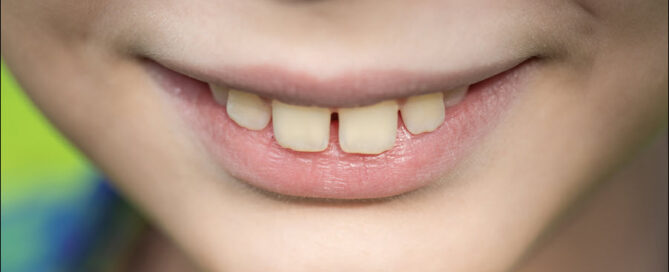 Overbite